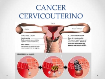Cáncer Cérvicouterino: se estima que cerca del 30% de las mujeres menores de 30 años porta el virus.